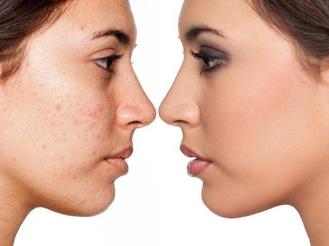 صورت زن قبل و بعد از استفاده از صابون گیاهی آلوئه ورا - صابون گیاهی آلوئه ورا